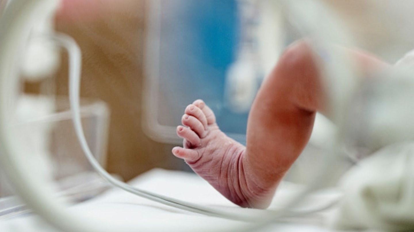 Apert syndrome