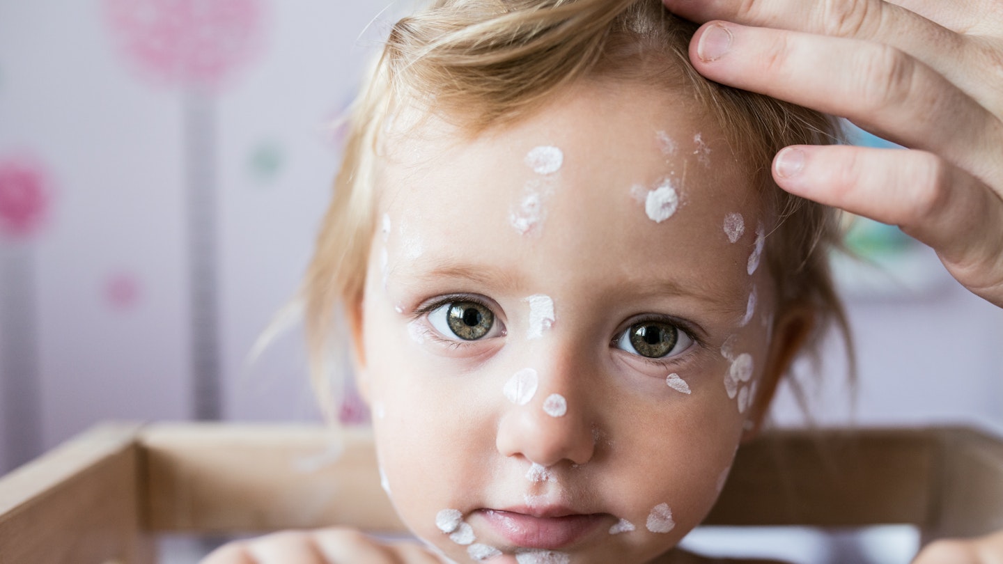 Everything you need to know about Chicken pox